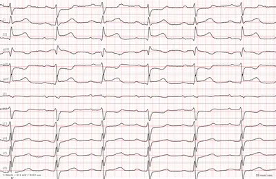 Элевация сегмента ST и инфаркт миокарда - E-Cardio
