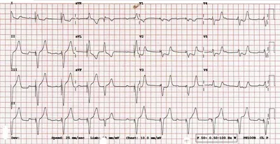 Помогите расшифровать кардиограмму | Пикабу