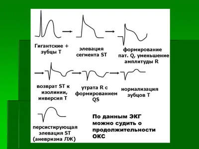 ЭКГ при инфаркте миокарда