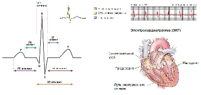 STEMI - инфаркт миокарда с элевацией ST