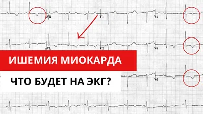 На ЭКГ блокада сердца: что это значит, простыми словами.