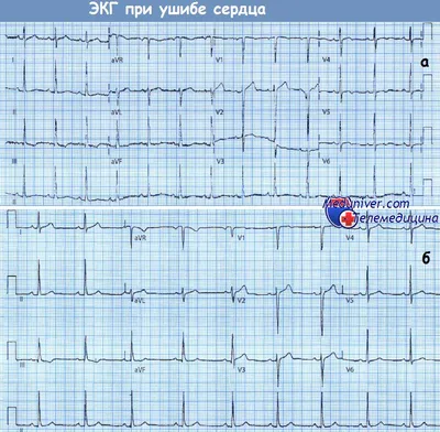 Mediscan, комплексная диагностика - Электрокардиография (ЭКГ) сердца❤️ ⠀  Электрокардиография (сокращенно ЭКГ) – это диагностический метод оценки  функций сердца путем измерения его электрической активности. Аппарат,  который регистрирует ЭКГ ...