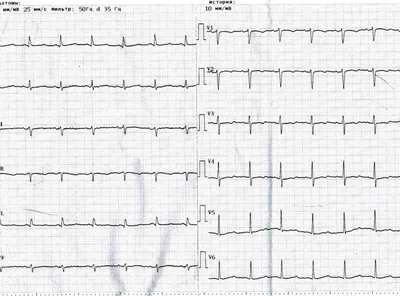 Электрокардиография с нагрузкой | Детский медицинский центр \"ЧудоДети\"