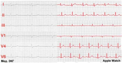Экстрасистолы на ЭКГ или холтере. Значение для здоровья | Патолог | Дзен