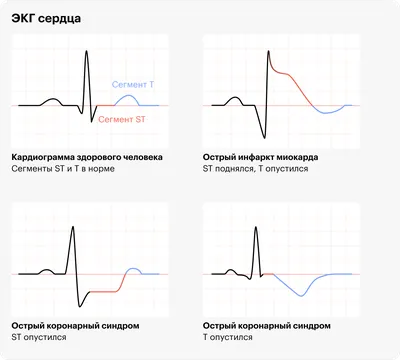 Сердце С ЭКГ Линии Для Кардио, Темы Здоровья Сердца Клипарты, SVG, векторы,  и Набор Иллюстраций Без Оплаты Отчислений. Image 47315246