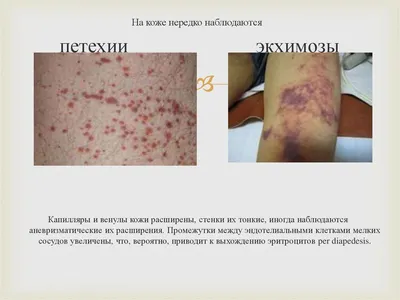 Синдром Иценко-Кушинга - online presentation