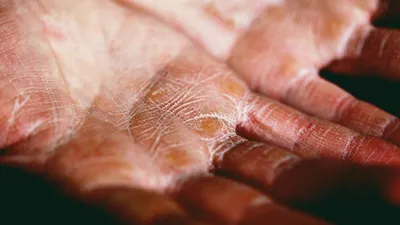 А-Медика» Медицинский центр - 👇 Лечение хронической экземы кистей. Экзема  кистей рук – одна из наиболее тяжелых форм заболевания, поскольку руки  человека задействованы во всех привычных повседневных делах и работе. 📝  Запишитесь