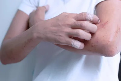 Крем Belupo для наружного применения Белодерм - «Хроническая экзема кистей  рук. Сводящий с ума зуд и бессоные ночи. Так было до знакомства с кремом  Белодерм. Применение на лице у взрослых и детей
