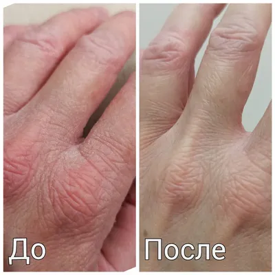 На помощь - кожа рук в ужасном состоянии | Косметиста