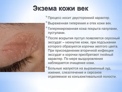 Блефарит: симптомы, причины, лечение этого заболевания глаз. - Всё о зрении.