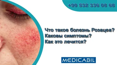 Инфекционный конъюнктивит. Симптомы и лечение. Барселона | ICR