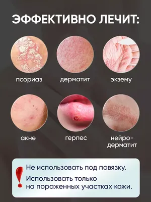 Иллюстрация 8 из 12 для Атопический дерматит и экзематозные расстройства -  Рудикофф, Коэн, Шайнфельд | Лабиринт - книги.