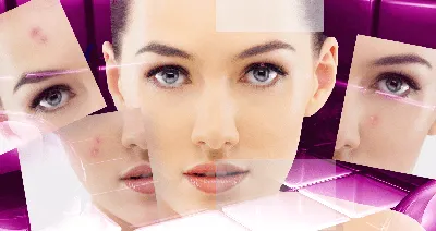 Blog | Что такое болезнь Розацеа? Каковы симптомы? Как это лечится?