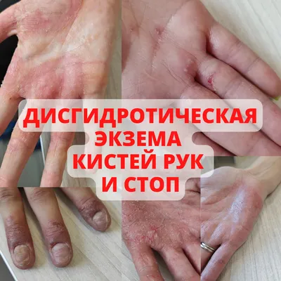 Экзема на руках - Эпидемиолог.ру