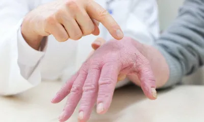 Правильное лечение экземы на руках в клинике ПсорМак, ремиссия до 5-6 лет