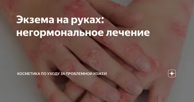 Экзема - причины, симптомы и лечение | Описание заболевания - meds.ru