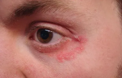 Экзема век, также известная как дерматит век, является распространенным  заболеванием, которое поражает нежную кожу вокруг глаз. Симптомы:… |  Instagram