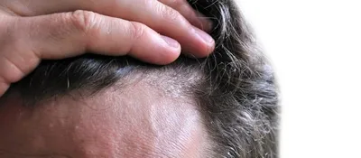 Препарат от экземы восстанавливает рост волос у пациентов с многолетней  алопецией :: Новости :: Новости трихологии