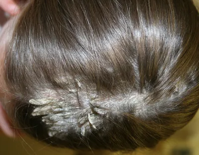Экзема волосистой части кожи головы: симптомы, причины, лечение