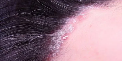 Натуральная сухая Раздраженная кожа и сухая кожа головы/экзема, приятное  для псориаза лечение перхоти зуд и шелушение кожи головы | AliExpress