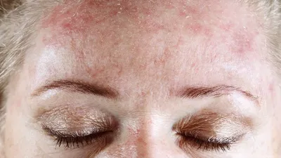 Дерматологическая кожная болезнь псориаз, экзема, дерматит, аллергия Ущерб  от кожи на голове Стоковое Фото - изображение насчитывающей боль, здоровье:  156141324