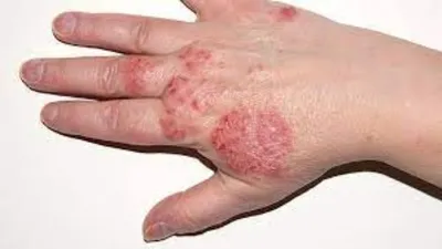 Заболевания кожи