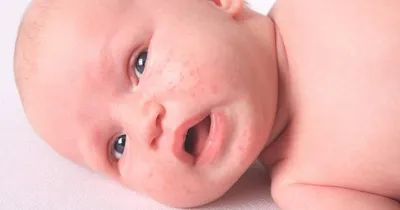 Seborrheic дерматит на голове новорожденного ребенка. Себорея атопический  дерматит на лбу стороны ребенка Стоковое Фото - изображение насчитывающей  экзема, лоб: 213427652