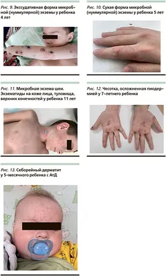 Себорейный дерматит: на голове и лице, лечение, симптомы, жирная и сухая  формы, причины