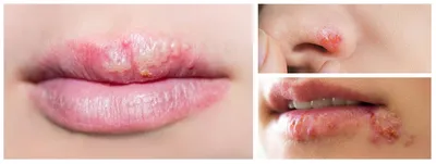 Yaroslav Lata M.D. - В холодное время года, часто нежные детские губы  пересыхают, необходимо вовремя это заметить. На фото мы видим периоральный  дерматит в следствии постоянного облизывания губ. Защитные бальзамы для губ