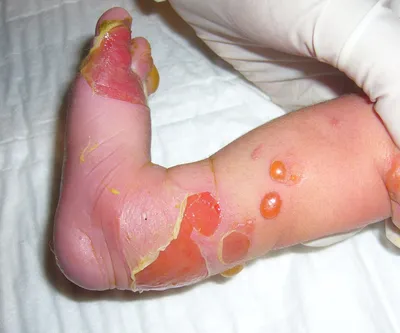 Отличия псориаза и дерматита – как определить заболевание