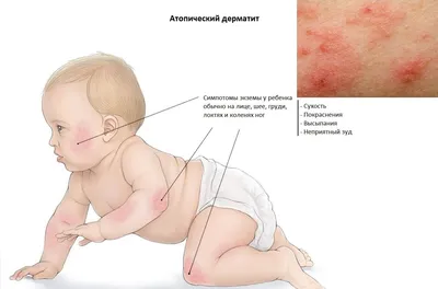 Эффективность лечения кожных заболеваний (псориаз, атопический дерматит)  кремом «КАРТАЛИН» - Kartalin - официальный представитель в Украине