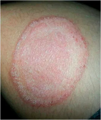 грибковая инфекция, называемая \"олеа корпорейс\" в ноге. широко  распространенный рингчервяк над коленой зоной Стоковое Фото - изображение  насчитывающей грибок, метка: 229678202