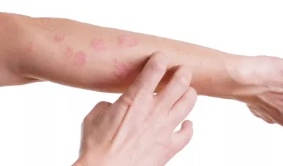 Человек зуд и крепко держит руку от зудящего дерматита экземы сухой кожи  Стоковое Изображение - изображение насчитывающей москит, боль: 175684645