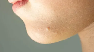Имитаторы атопического дерматита: заболевания кожи, о которых нужно помнить  при диагностике | Ординаторская.онлайн | Ординаторская онлайн