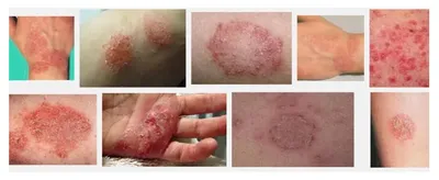 Крем для кожи рук и ног дерматит от экземы псориаз, крем от зуда, 50 г, 50  мл | AliExpress