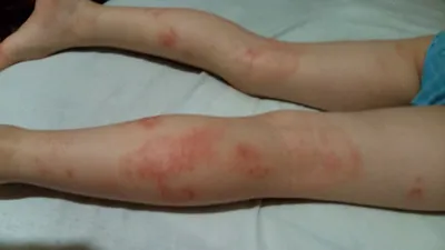 Выборочный и мягкий фокус красного воспаления пятен и кожи аллергия на ногах  ребенка Стоковое Фото - изображение насчитывающей экзема, взорвать:  210858182