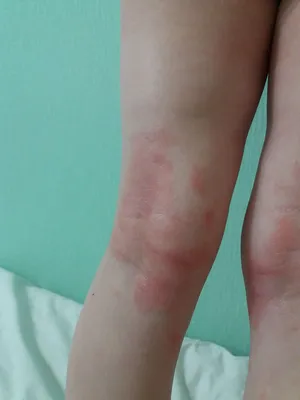 Атопический дерматит на ногах у ребенка лечение | Премиум Фото