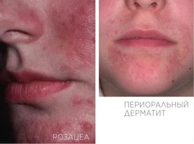 Периорифициальный дерматит - заболевание кожи , при котором в зоне вокруг  рта (периоральный), глаз (периорбикулярный), носа появляются… | Instagram
