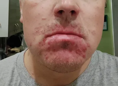 Розацеа как отличить от акне и периорального дерматита | DermaQuest | Дзен