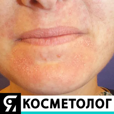 Комбинированная чистка лица у косметолога: цена от 2990 рублей в Москве |  Механическая и ультразвуковая чистка лица в клинике BeautyWay Clinic