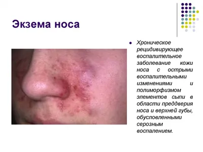 Дерматит: лечение атопического и себорейного дерматита у детей и взрослых