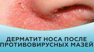 Маскне»: акне, вызванное ношением масок, и другие дерматозы