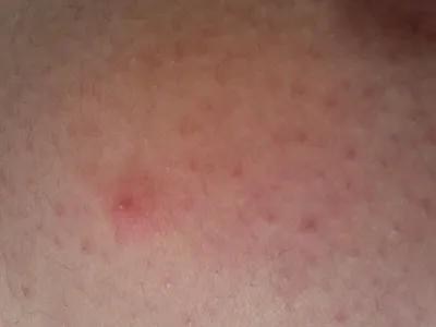 Почему чешутся соски и как избавиться от зуда - Лайфхакер