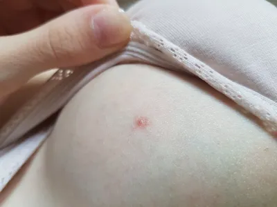 Рак Педжета: рак молочной железы фотографии, начальная стадия болезни  Педжета молочной железы | Клиники «Евроонко»