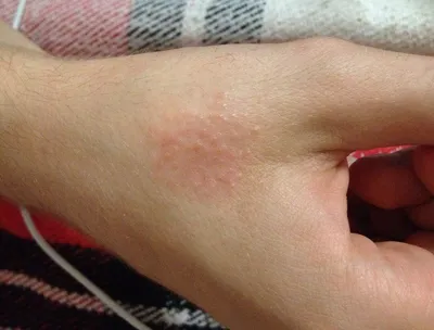 Аллергический дерматит на руках: лечение дерматита на пальцах рук