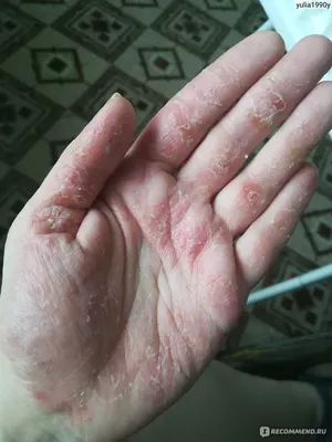Атопический дерматит экземы Witn между пальцами рук ребенка Стоковое  Изображение - изображение насчитывающей перста, болезнь: 176729569