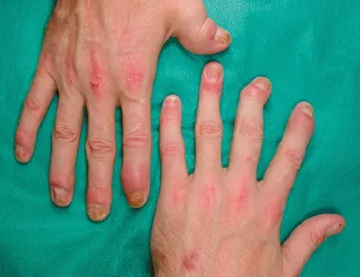 Сухие руки, кожура, контактный дерматит, грибковые инфекции стоковое фото  ©Aboutnuylove 140921290