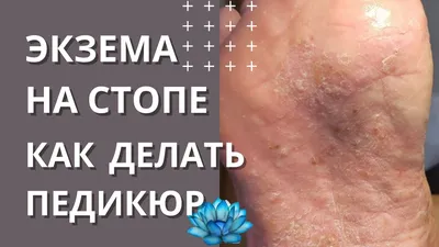 Экзема: патология, лечение, помощь пациентам в кабинете косметолога - в  Москве