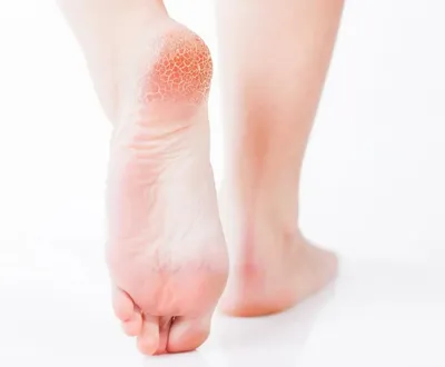 Аллергический дерматит на ногах: причины, признаки и лечение