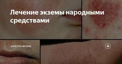 Крапивница: симптомы и лечение — причины появления у взрослых и детей,  лекарства от болезни